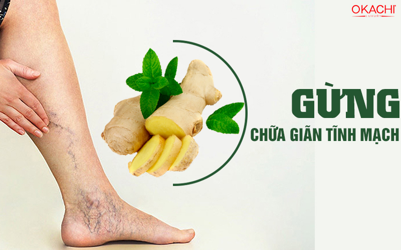 Sử dụng gừng chữa giãn tĩnh mạch DỄ thực hiện