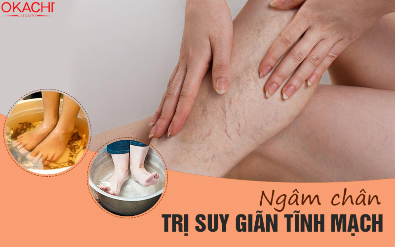 Ngâm chân trị suy giãn tĩnh mạch sao cho ĐÚNG NHẤT