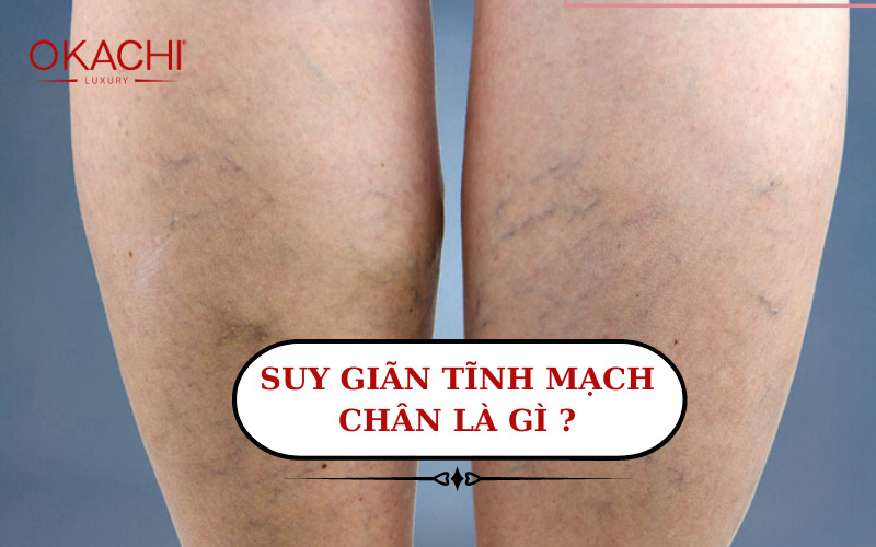 Suy giãn tĩnh mạch chân là gì và cách điều trị THEO các chuyên gia
