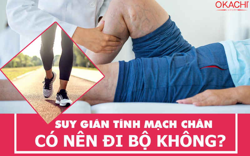 Suy giãn tĩnh mạch chân CÓ NÊN đi bộ không?