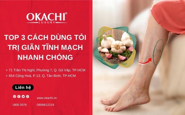 Top 3 Cách dùng tỏi trị giãn tĩnh mạch NHANH CHÓNG